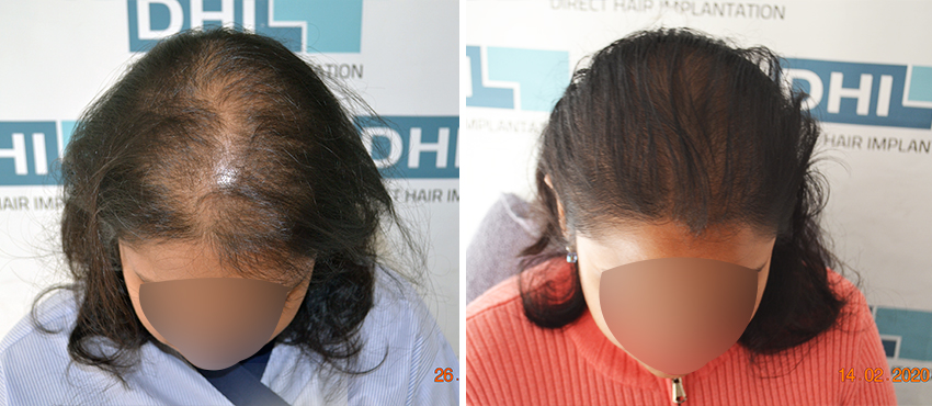 DHI before & after hair transplant results